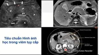TIẾP CẬN ĐIỀU TRỊ VIÊM TỤY CẤP | PGS. TS. BS. BÙI HỮU HOÀNG
