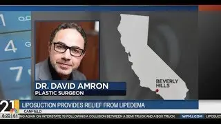 Dr. David Amron and Lipedema Patient Featured on WFMJ Ohio News
