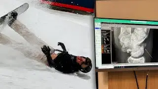 GIJS BREEKT HAND BIJ SNOWBOARD TRUC