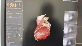 Contrast Speed Tips for Perfect Coronary Scan