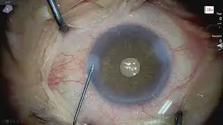 Ophthalmic surgery live 18+ Lukan Mishev