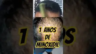 Minoxidil e finasterida #quedadecabelo #calviciemasculina #calvicie  #minoxidil  #finasterida