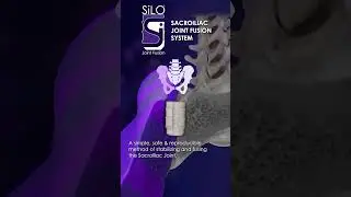 SiLO&trade; a single implant posterior SI fusion #patientsfirst #PurposeDriven #medicalanimation
