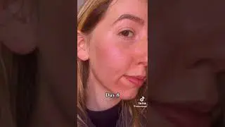 ZENA Algae Peeling the Result of the Procedure from 1 to 8 days