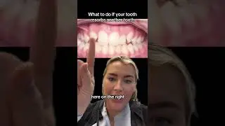 what happens if your tooth is resorbed! #impactedcanines #braces #bracestips