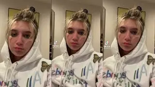 Mads Lewis days after breakup with Jaden + Healing from plastic surgery