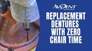 The AvaDent Denture Advantage - Replacing A Lost Denture