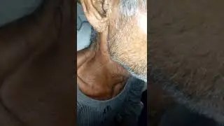 Dancing carotid sign in Aortic regurgitation