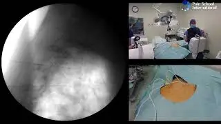 Dr Agnes Stogicza - Radiofrequency E-Learning Seminar 6 Session 2: Thoracic sympathectomy