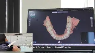 NeoScan 1000 - real time intra-oral scanning