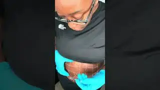 Watch Me Do Fat Dissolving Injections On Myself | Pain Free | Lose Inches | #fatreduction