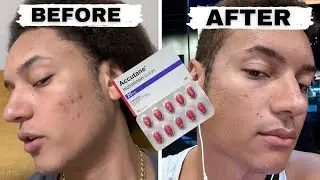 2 Months After Stopping Accutane - Oily & Sensitive Skin (Post Acne Medication Update) Dercutane