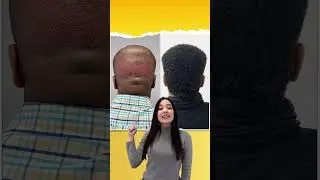 Comparativa antes y despu&eacute;s del trasplante capilar. 2.500 f&oacute;licos 🙌🏻 | Care4Hair