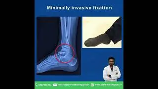 Talus neck fracture (Ankle fracture)