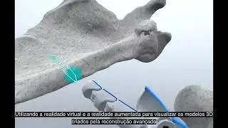Medical Advanced 3D Reconstruction- Using AR/VR Shoulder CT