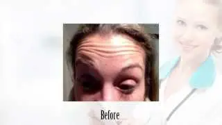 Botox in Princeton NJ Before & After
