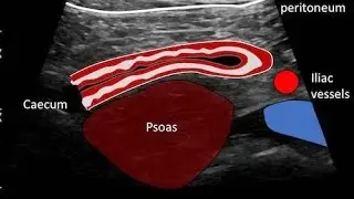 Appendicitis Ultrasound