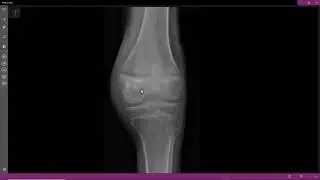 Condroblastoma