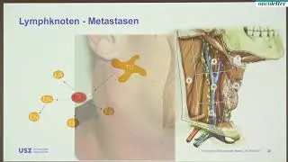 PD Dr. med. Martina Broglie D&auml;ppen: Was versteht man unter Kopf-Hals-Tumoren?