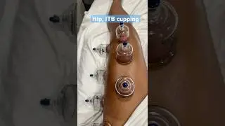 Cupping to relieve tightness in the hip flexors, quads, and ITB. #cupping #massage #asmr