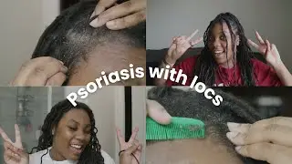 How I Maintain Scalp Psoriasis with Locs | DON'T CUT YOUR HAIR!