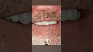A New Confident Smile Makeover Review! - No Dentist Needed!