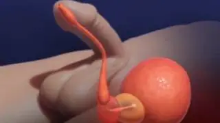 TUMT painful catheterization - a new alternative and patient's interview