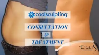 CoolSculpting Consultation and Treatment