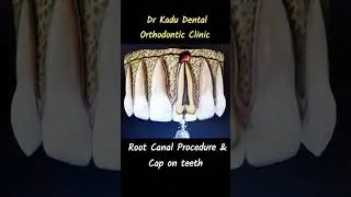 Root canal Animation,#Root canal tratment|Cap on teeth, #dentist,#trending,#viral,#new,#ytshorts,#dr