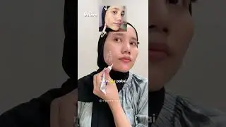 Touched, My Inflamed Acne Can Be Cured Using Skin Game Acne Warrior, Use It Regularly and Really ...