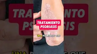 As&iacute; trato la psoriasis de mis pacientes #salud #psoriasis #piel #dermatitis #nutricion