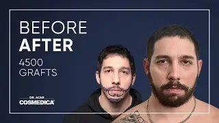 Hair Transplant in Turkey | Results | Dr. Acar | Cosmedica Clinic