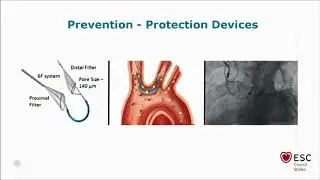 Stroke due to cardiac interventions – how big are the risks we take