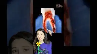 Procedura pe care ti-o face dentistul c&acirc;nd ai o infectie la dinte 😱