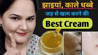 झाइयों, काले धब्बों, पिंपल्स मार्क्स के लिए Best Cream || How to Remove Pigmentation & Dark Spots