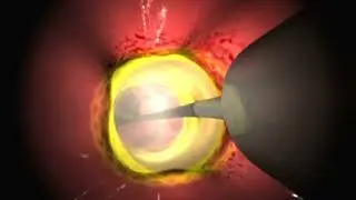 Radiofrequency ablation of the esophagus