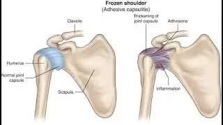 Capsulitis; inflammation of a joint capsule, fibrous tissue that surrounds and stabilizes a joint