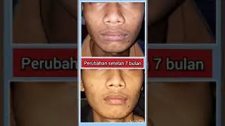 7 bulan perawatan behel gigi tonggos