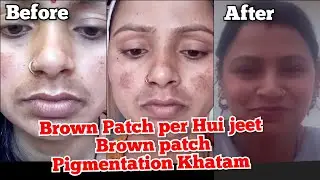 Brown Patch per hui jeet BROWN patch Pigmentation Khatm | Pigmentation Removing Bumper Remedy