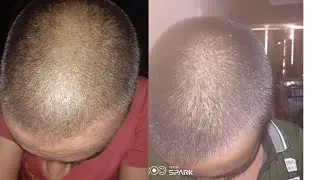 20 days of using minoxidil| minoxidil morr f10 % results