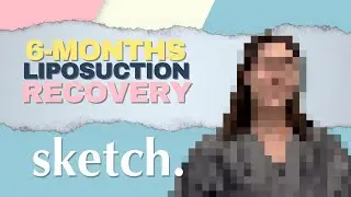 Lydia&rsquo;s 6-Month Liposuction Update | Sketch Plastic Surgery