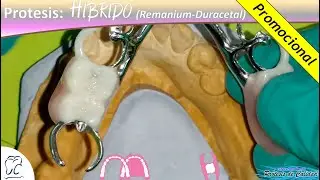 Pr&oacute;tesis: H&iacute;brida (Remanium-Duracetal) Caso 03