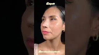 Rinoplast&iacute;a Ultras&oacute;nica Cerrada