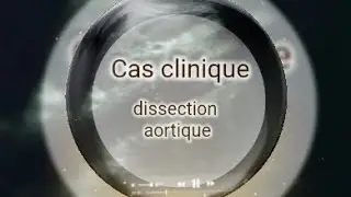 Formation : dissection aortique + adenopathie profonde .