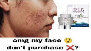 OMG my Face 😱 ।। Lotus Herbals whiteglow night cream review ।। Honest review