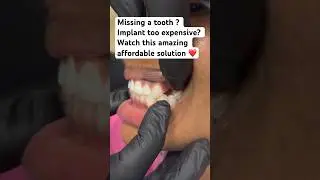 Missing tooth ? Implant too pricey? Watch this simple affordable amazing solution ❤️!