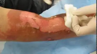 Burn Wound Cleansing