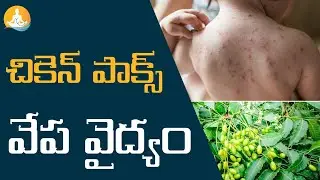 Chickenpox Symptoms and Natural Treatment|#chickenpox #fever #seasonaldiseases #neemleaves #skincare