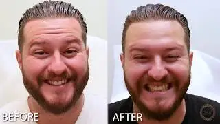 Botox Before & After For Men - Irvine, CA (Using Botox, Xeomin, Dysport)