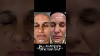 Say goodbye to hyperpigmentation! IPL laser reveals a clearer, radiant complexion